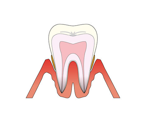 歯周病