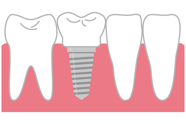 インプラント