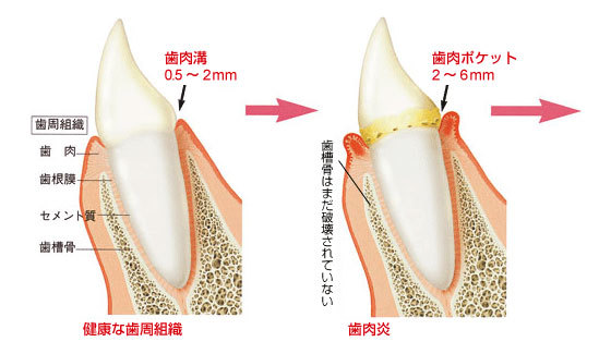 歯周病1