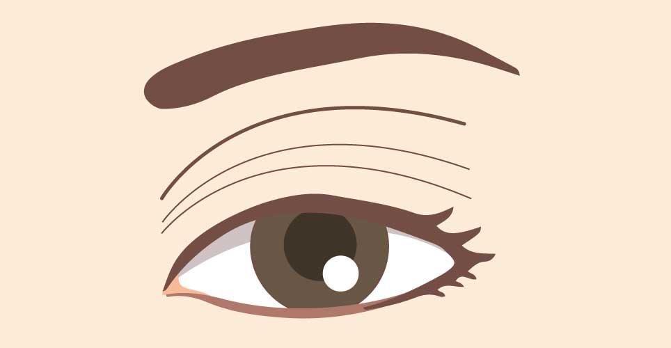 7.まぶたが落ちる (眼瞼下垂)