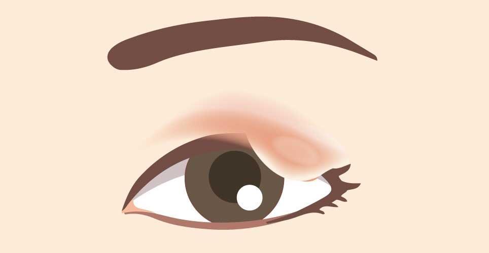 8.まぶたのしこり (眼瞼腫瘍)