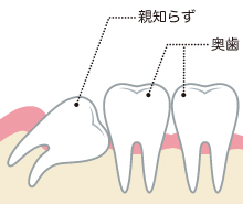 親知らず