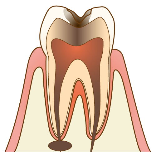 虫歯の進行段階c3