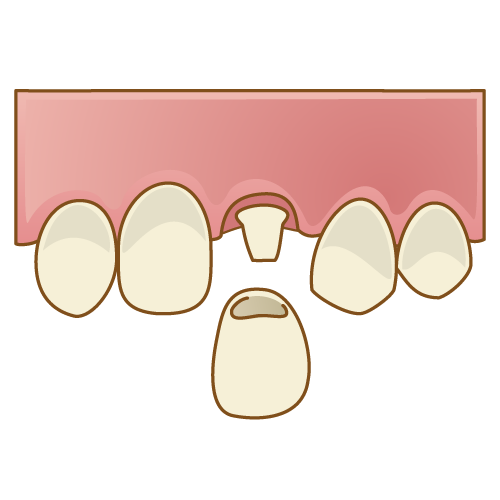 クラウン（被せ物）