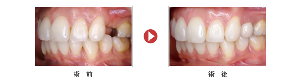 implant