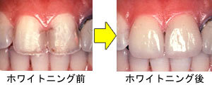 whitening-img-06