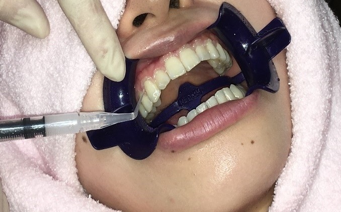 オフィスホワイトニングの手順2