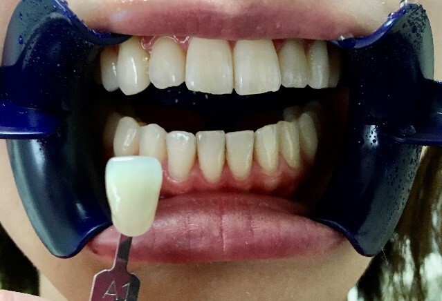 ホームホワイトニングの手順3