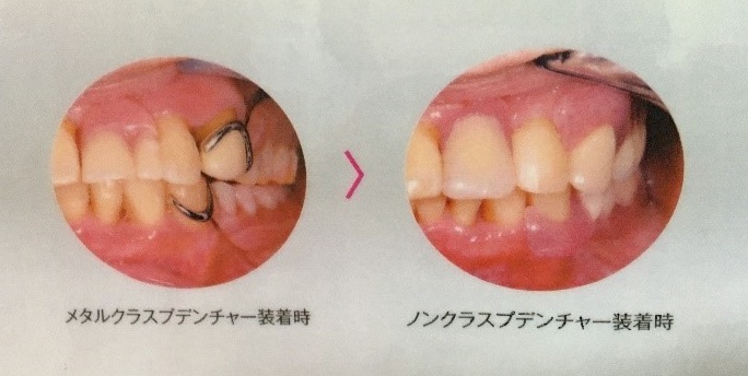ノンクラスプデンチャー