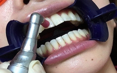 オフィスホワイトニングの手順1