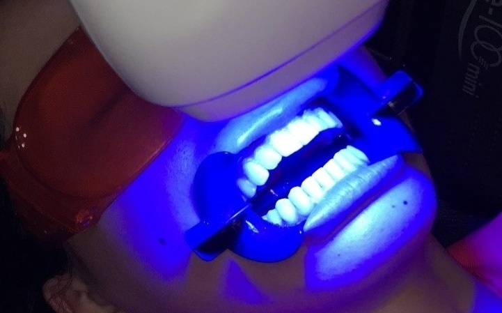 オフィスホワイトニングの手順3