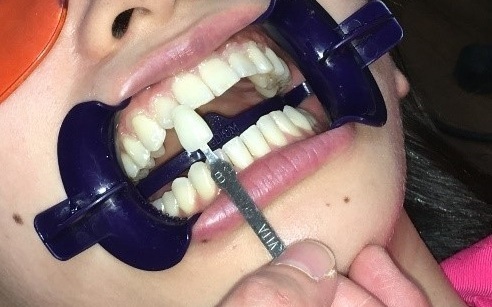 オフィスホワイトニングの手順4