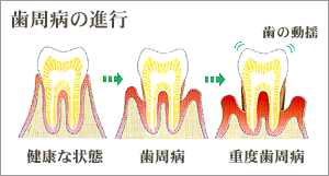 歯周病の進行