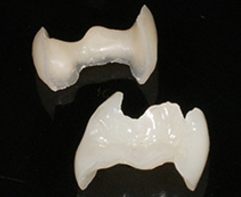 コンポジットレジンインレー