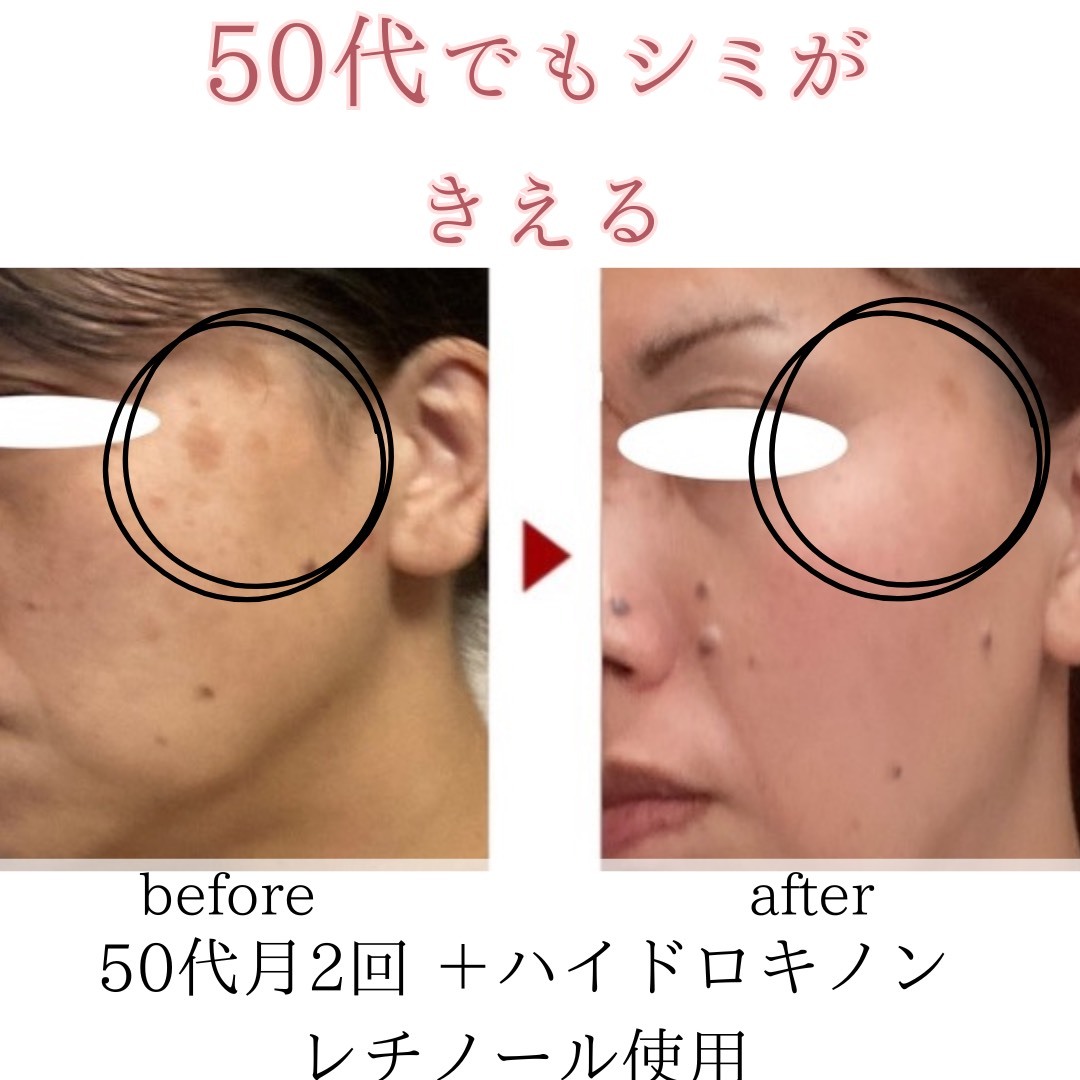 ビフォーアフターのテンプレパターンのコピー (1)