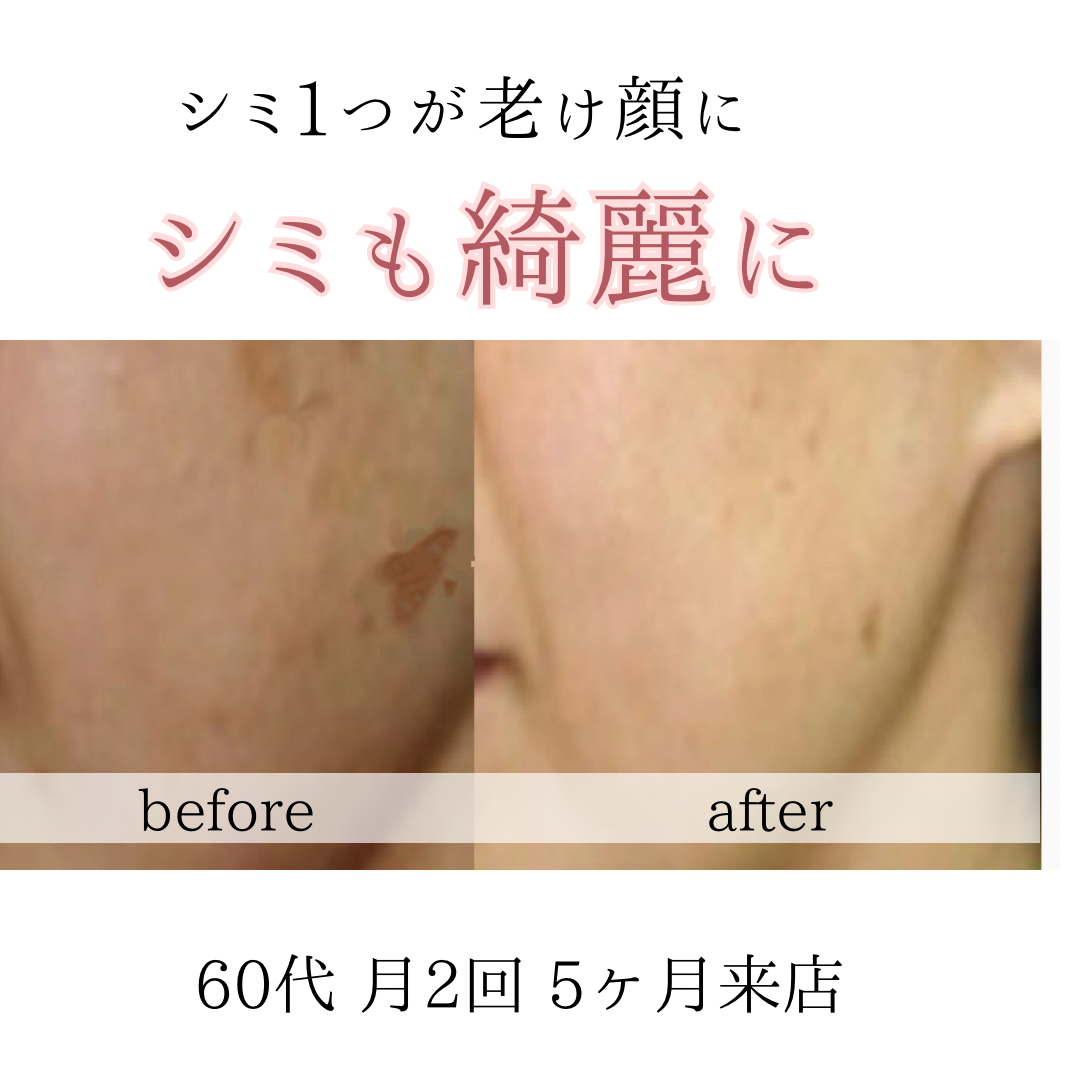 ビフォーアフターのテンプレパターンのコピー (2)