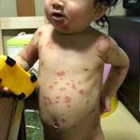 1歳 男児 アトピー性皮膚炎の症例