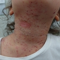 6歳 女児 急性アトピー性皮膚炎の症例