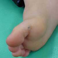 5歳 男児 魚の目の症例