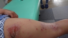 急性アトピー性皮膚炎の症例:足(施術前)