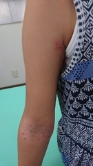 急性アトピー性皮膚炎の症例:腕(施術前)