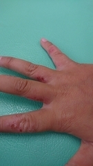 急性アトピー性皮膚炎の症例:手(施術前)