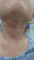 急性アトピー性皮膚炎の症例:首(施術前)