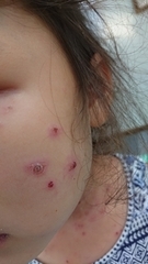 急性アトピー性皮膚炎の症例:顔(施術前)