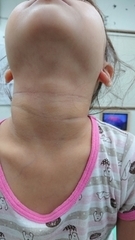 急性アトピー性皮膚炎の症例:首(施術後)