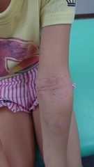 急性アトピー性皮膚炎の症例:腕(施術後)