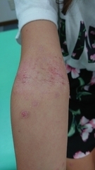 急性アトピー性皮膚炎の症例:腕(施術後)