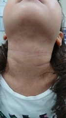 急性アトピー性皮膚炎の症例:首(施術後)