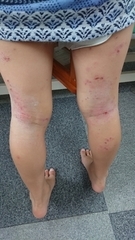 急性アトピー性皮膚炎の症例:足(施術後)