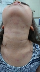 急性アトピー性皮膚炎の症例:首(施術後)