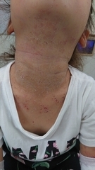 急性アトピー性皮膚炎の症例:首(施術後)