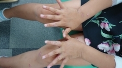 急性アトピー性皮膚炎の症例:手(施術後)