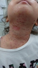 急性アトピー性皮膚炎の症例:首(施術後)