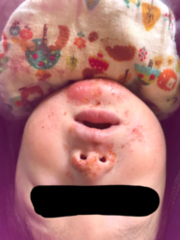 アトピー性皮膚炎の症例:顔(施術前)
