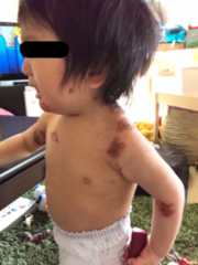 アトピー性皮膚炎の症例:体(施術前)