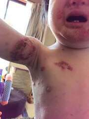 アトピー性皮膚炎の症例:体(施術前)