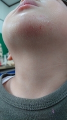 アトピー性皮膚炎の症例:顔(施術後)