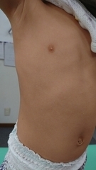 アトピー性皮膚炎の症例:体(施術後)