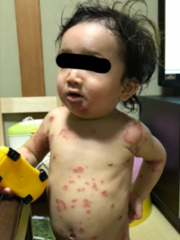 アトピー性皮膚炎の症例:体(施術前)