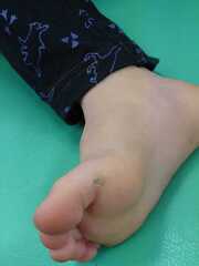 5歳 男児 魚の目の症例 初回