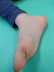 5歳 男児 魚の目の症例 途中経過