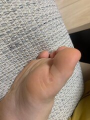 5歳 男児 魚の目の症例 完治