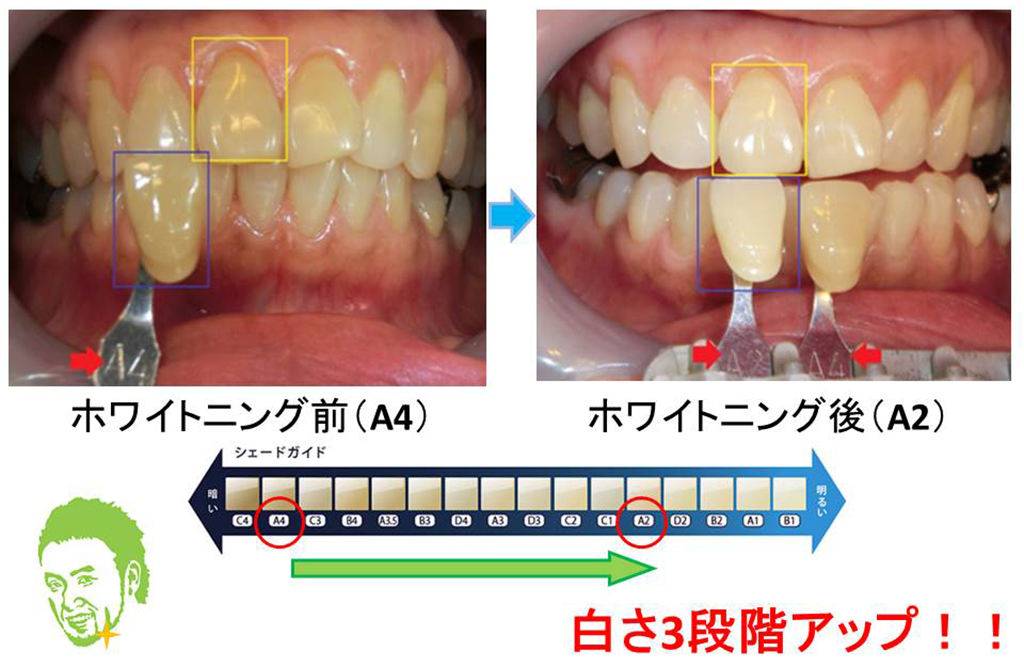 ホワイトニング07