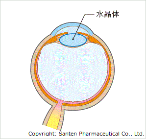 白内障の図