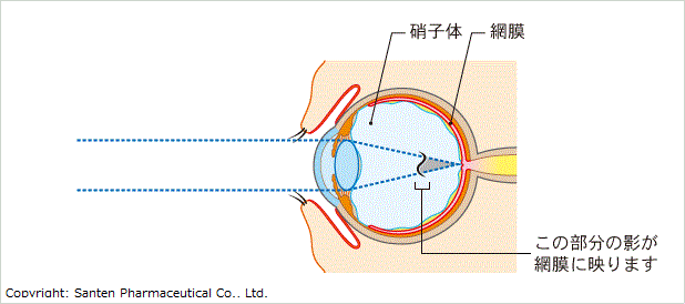 飛蚊症の図