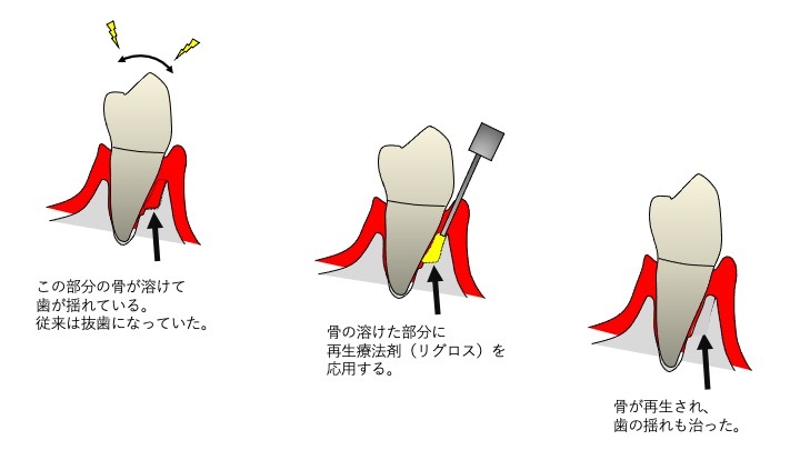 挺出と再生療法の絵